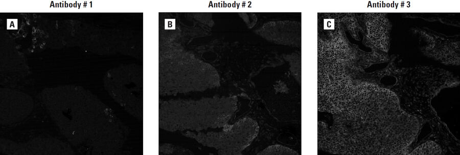 Figure 3: A comparison of three antibodies against cMET. FFPE tissue samples from bladder transitional cell carcinoma stained with antibodies against tyrosine-protein kinase cMET from different vendors. (A) Antibody #1 shows specificity but low sensitivity. (B) Antibody #2 is sensitive but not specific. (C) Antibody #3 is both sensitive and specific for the detection of cMET.