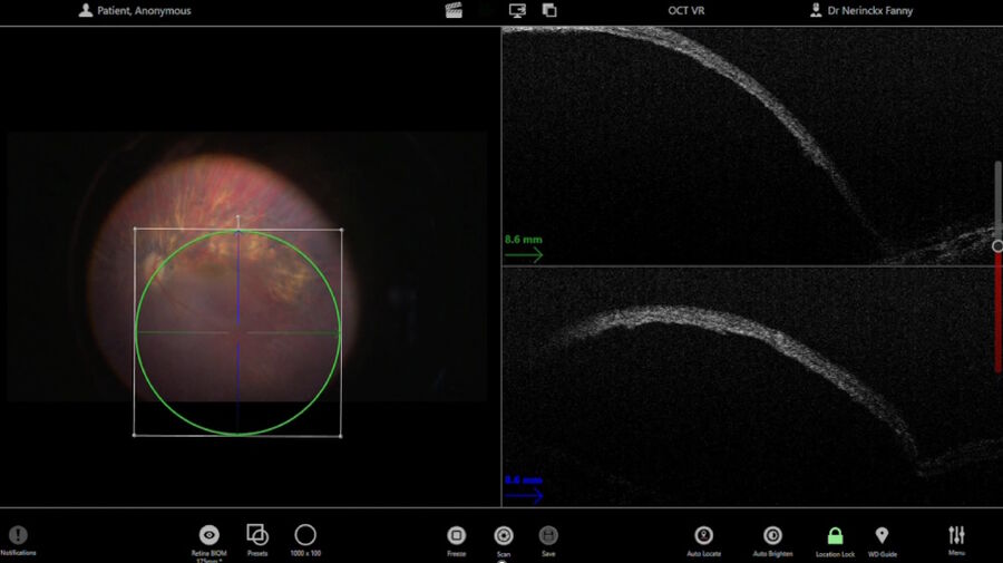图 6：Nerinckx 博士在注射后利用脚踏板移动和控制 OCT 扫描，以检查黄斑中心凹拉伸情况并确认没有黄斑裂孔。