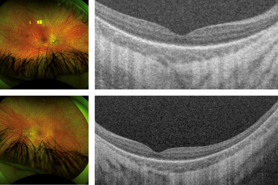 术前视网膜眼底成像显示血管轻度衰减，黄斑体积正常，椭圆体完整，没有明显的营养不良特征。图片由Robert Henderson先生提供