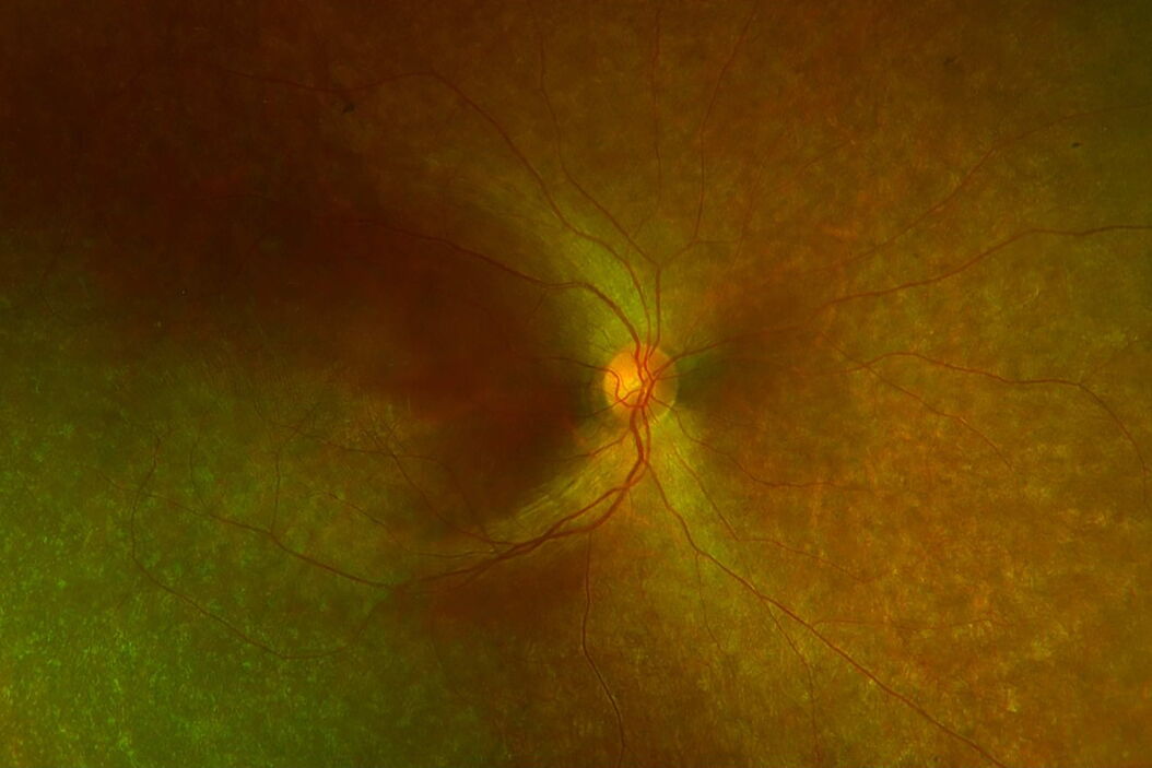 [Translate to chinese:] Diffuse retinal degeneration with relative macular sparing. Typical_diffuse_retinal_degeneration_with_relative_macular_sparing.jpg