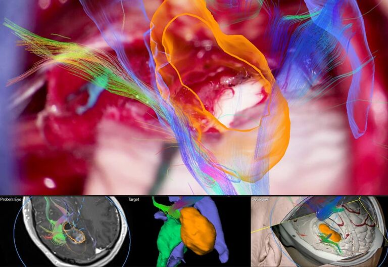 Neurochirurgie réalisée avec l'injection d'image CaptiView et le logiciel de Neuro-Navigation Cranial 3.1 de Brainlab.