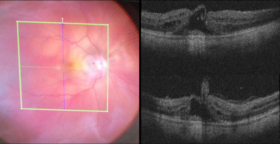 Vitrectomy for macular hole. The intraoperative OCT view shows the good position of the ILM flap covering the hole.