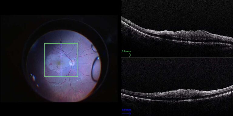 Visão microscópica da retina (esquerda) complementada com EnFocus OCT (direita) para visualizar as camadas da membrana durante a descamação da membrana. Imagem gentilmente cedida pelo Dr. Massimo D'Atri, Cagliari, Itália.