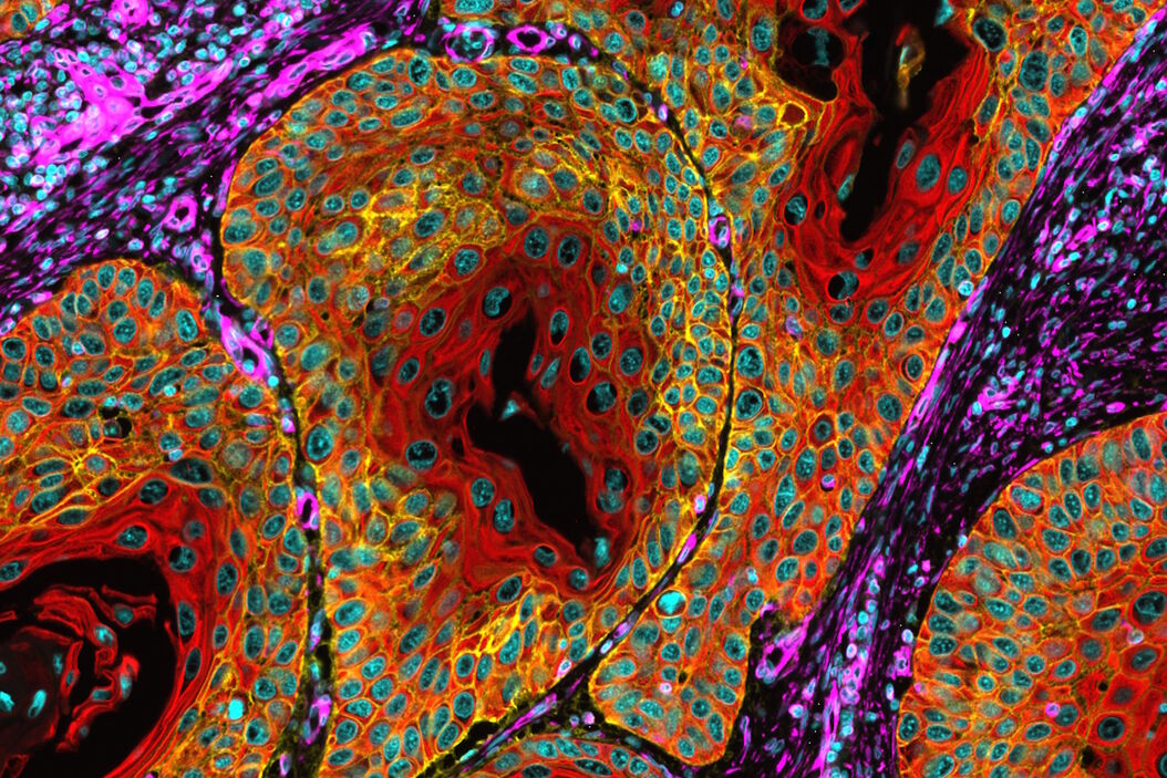 Esophageal tissue with a squamous cell carcinoma labelled with the 4 biomarkers PanCk, DAPI, NaKATPase, and Vimentin. Esophageal_Squamous_Cell_Carcinoma_4_Markers.jpg