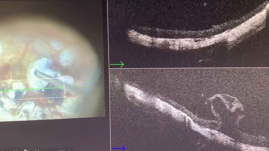 Vitrectomy and ILM peeling in a macular hole in a highly myopic eye.