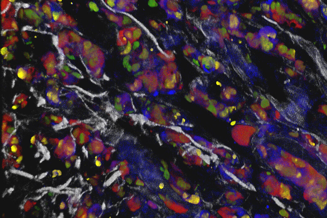 Colon tumor cells, fluorescently labelled and lineage traced from a multicolor tracer.  APP_SP8_DIVE_Tumor_ConfettiMouse_rgb.jpg
