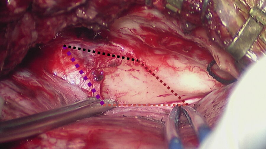 Lateral approach: anterior petrosectomy. Image courtesy of Prof. Roche.