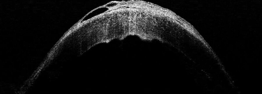 [Translate to chinese:] Intraoperative OCT image of the patient’s pathologic cornea. Image courtesy of Prof. Nikolaos Bechrakis. 