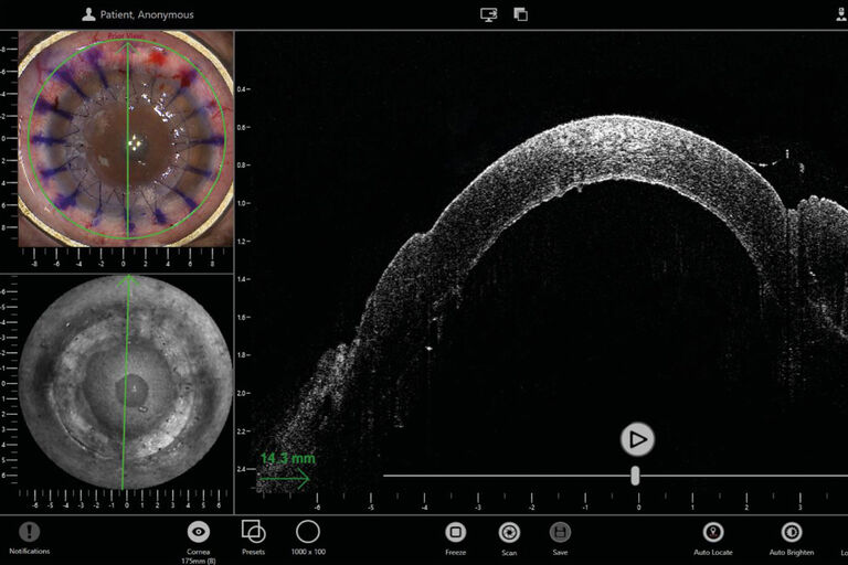 Software InVivo del sistema EnFocus de captura y procesamiento de imágenes de tomografía de coherencia óptica (OCT) intraoperatoria mostrando un procedimiento de córnea en vista cuádruple. Vea la imagen del microscopio arriba a la izquierda y la vista «en face» abajo a la izquierda, así como la imagen de exploración B de tomografía de coherencia óptica (OCT) a la derecha.