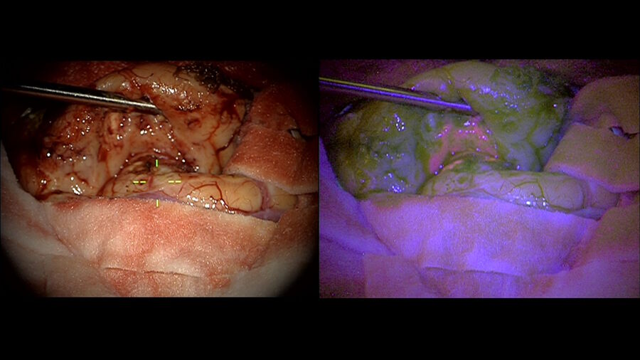 Operating on a brain tumor with 5-ALA fluorescence guidance. Image courtesy of Dr. Guirish Solanki.