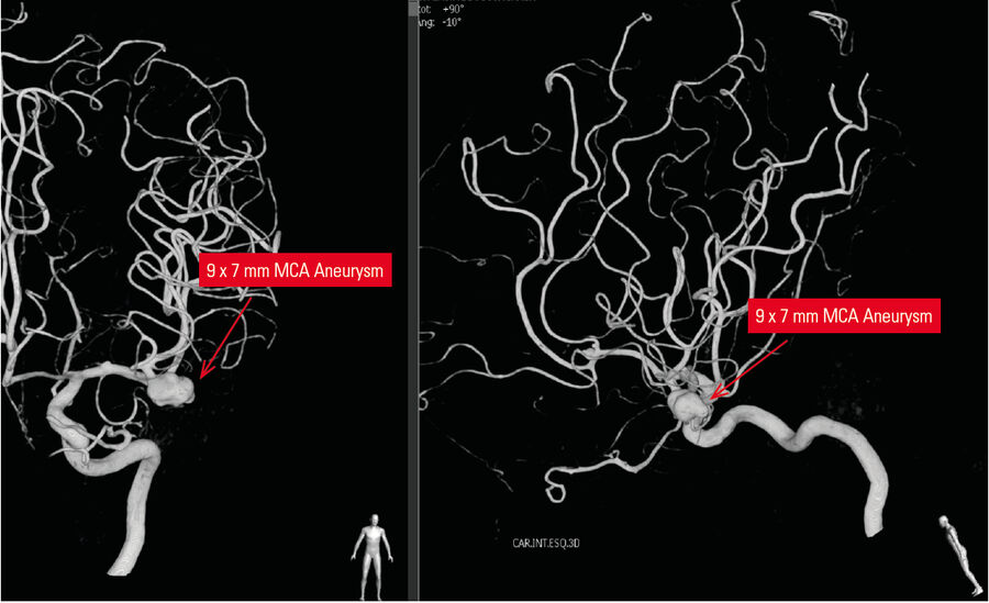 3D reconstruction showing the MCA aneurysm.