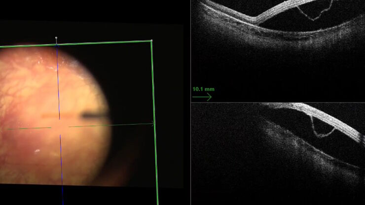 [Translate to chinese:] The intraoperative OCT showed the ellipsoid had separated from the inner retina with focal attachment to the retinal pigment epithelium (RPE). Images provided by Mr. Robert Henderson
