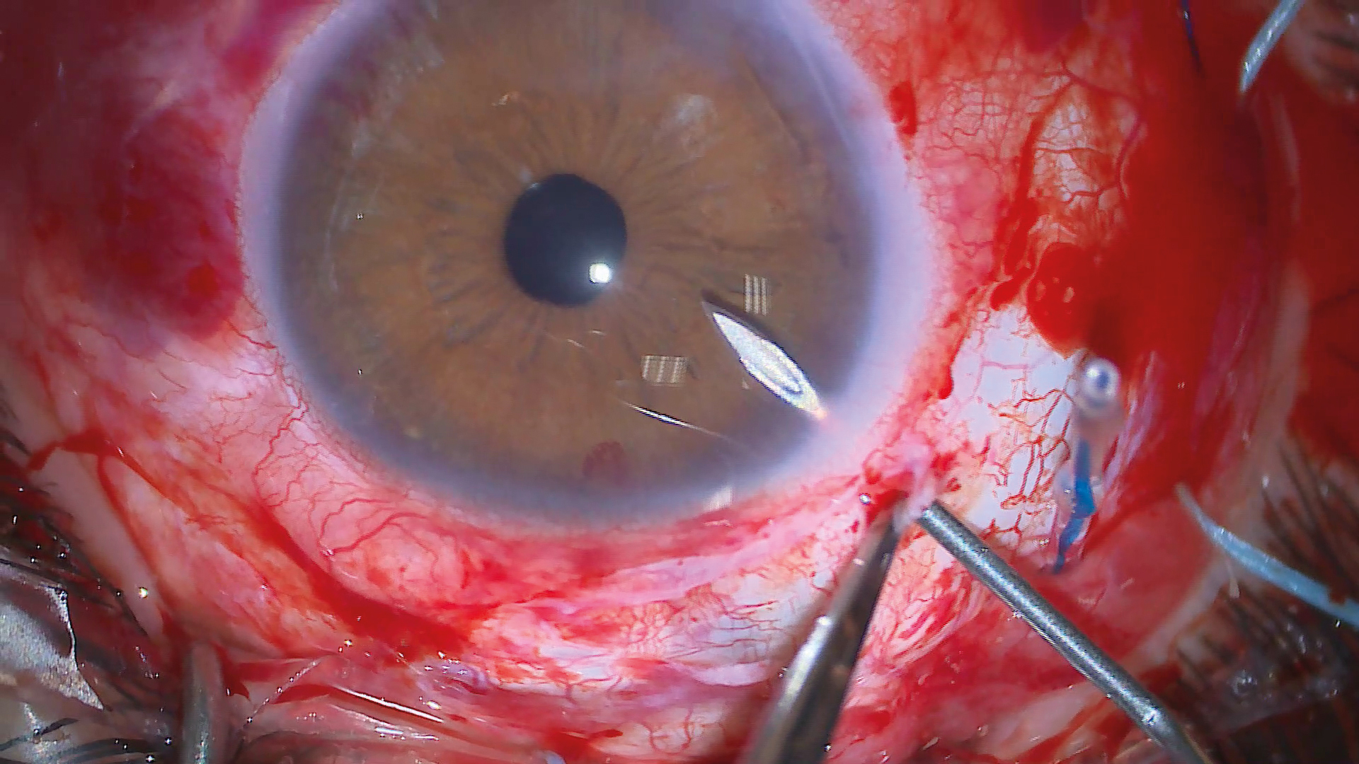 Image of a Glaucoma Surgery with a Leica Ophthalmic Microscope