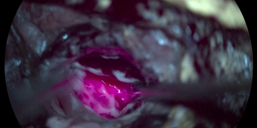 Fig. 4: GLOW400 AR Fluorescence in anatomy view, image courtesy of Prof. Kondo.