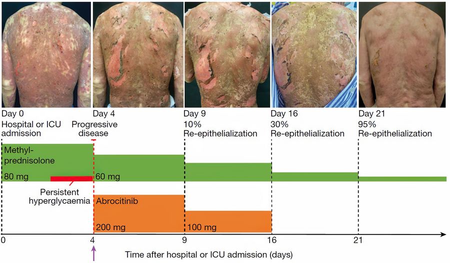 The progress over time shows the beneficial effect of JAK/STAT inhibition in patients with TEN (SCORTEN 4) associated with cancer treatment. The progress over time shows the beneficial effect of JAK/STAT inhibition in patients with TEN (SCORTEN 4) associated with cancer treatment.