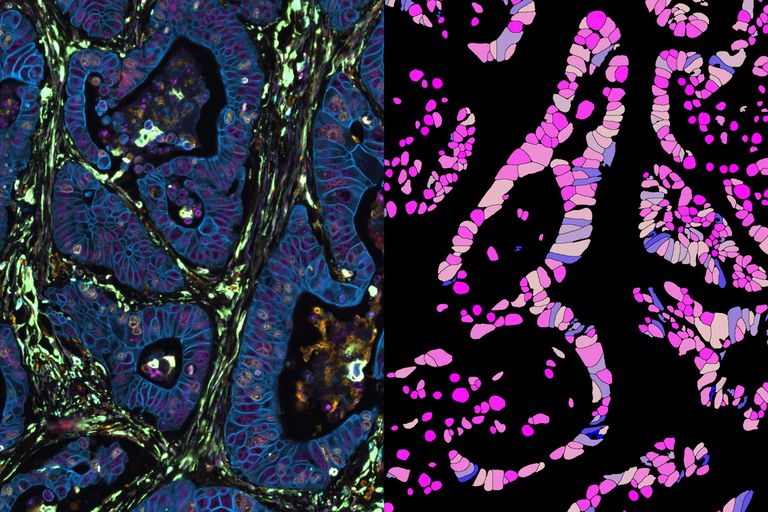 48 channel human colon channel image acquired on Leica Cell DIVE system, analyzed via Aivia Segment by Example and colored by circularity measurements. Image credit:  Melinda Hill, Ph.D. of Leica Microsystems, analyzed in Aivia by Quyen Tran, Ph.D. of Leica Microsystems
