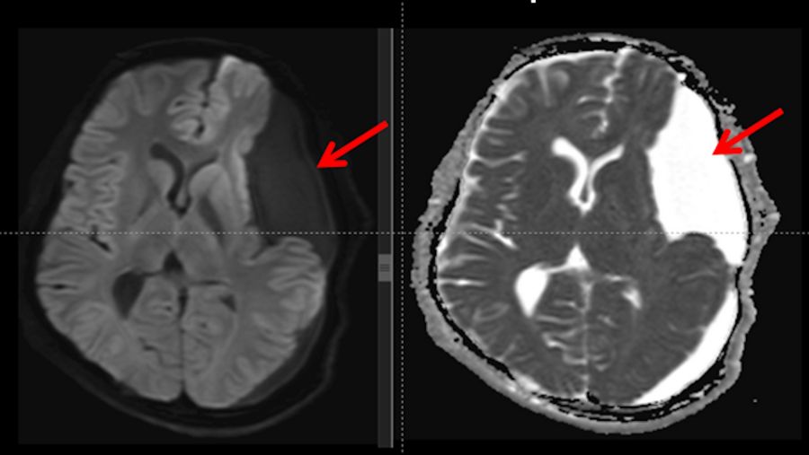Diffusion and ADC map sequences show a large arachnoid cyst with no diffusion restriction, excluding the possibility of a dermoid and epidermoid cysts, as well as that of an empyema and an abscess.