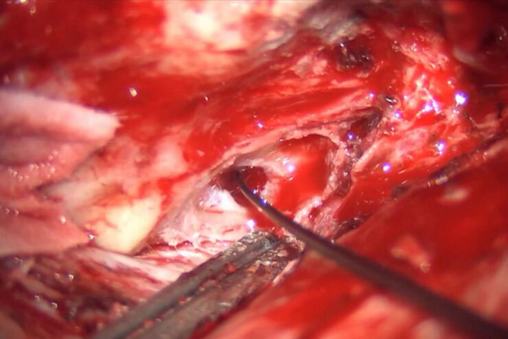 Skull base tumor removal. Image courtesy of Prof. Pierre-Hugues Roche. Skull base tumor removal. Image courtesy of Prof. Pierre-Hugues Roche.