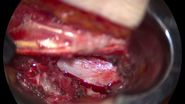 Surgical incision in minimally invasive spine surgery (MISS) case. Image courtesy of Dr. A. Alfieri, Chief Physician & Head of Clinic of Neurosurgery & Spinal Surgery, Cantonal Hospital Winterthur, Switzerland.