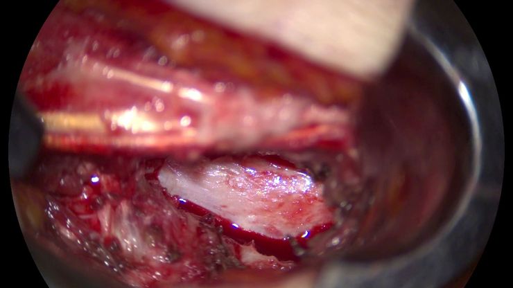 Surgical incision in minimally invasive spine surgery (MISS) case. Image courtesy of Dr. A. Alfieri, Chief Physician & Head of Clinic of Neurosurgery & Spinal Surgery, Cantonal Hospital Winterthur, Switzerland.