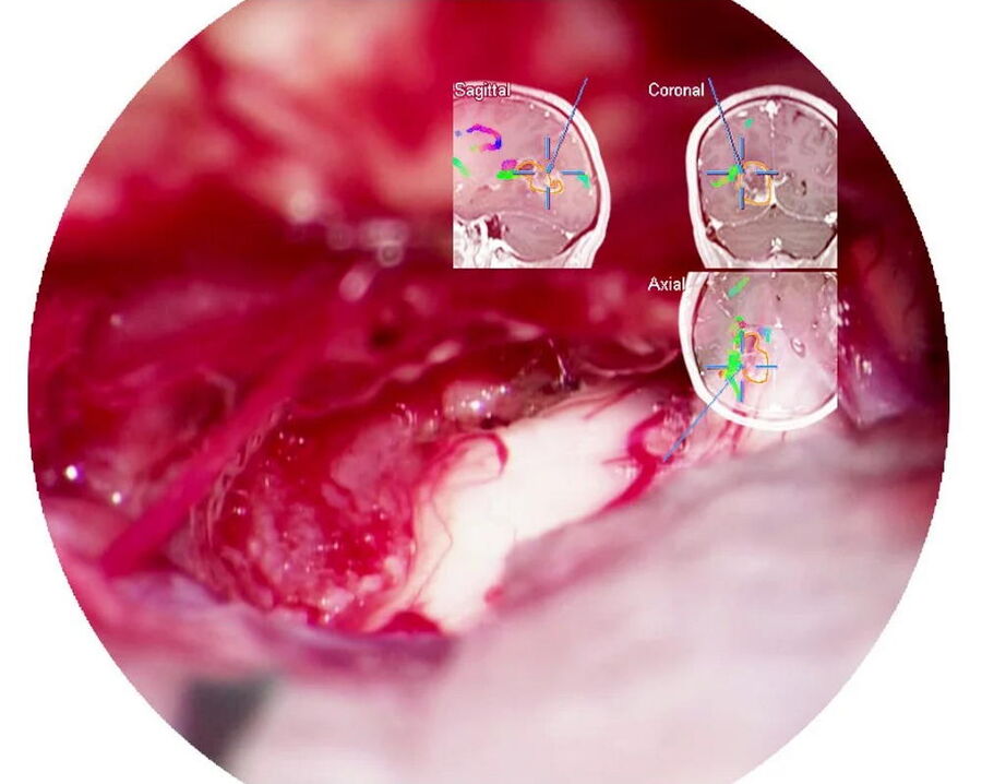 Microscope integration with Cranial Navigation application, viewed with CaptiView image injection.