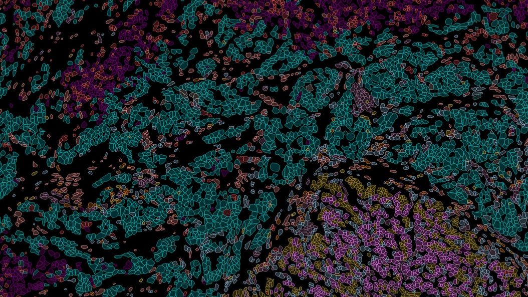 Pancreatic Ductal Adenocarcinoma imaged with Cell DIVE. Analysis done by Aivia. Pancreatic_Ductal_Adenocarcinoma_Cell_DIVE_with_analysis_by_Aivia.jpg