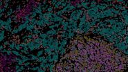 Pancreatic Ductal Adenocarcinoma imaged with Cell DIVE. Analysis done by Aivia.