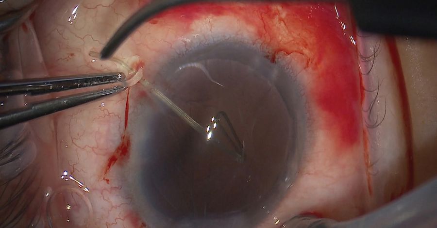 Removal of retractors while twisting to avoid the endothelium. Image courtesy of Arsham Sheybani, MD, Washington University School of Medicine.
