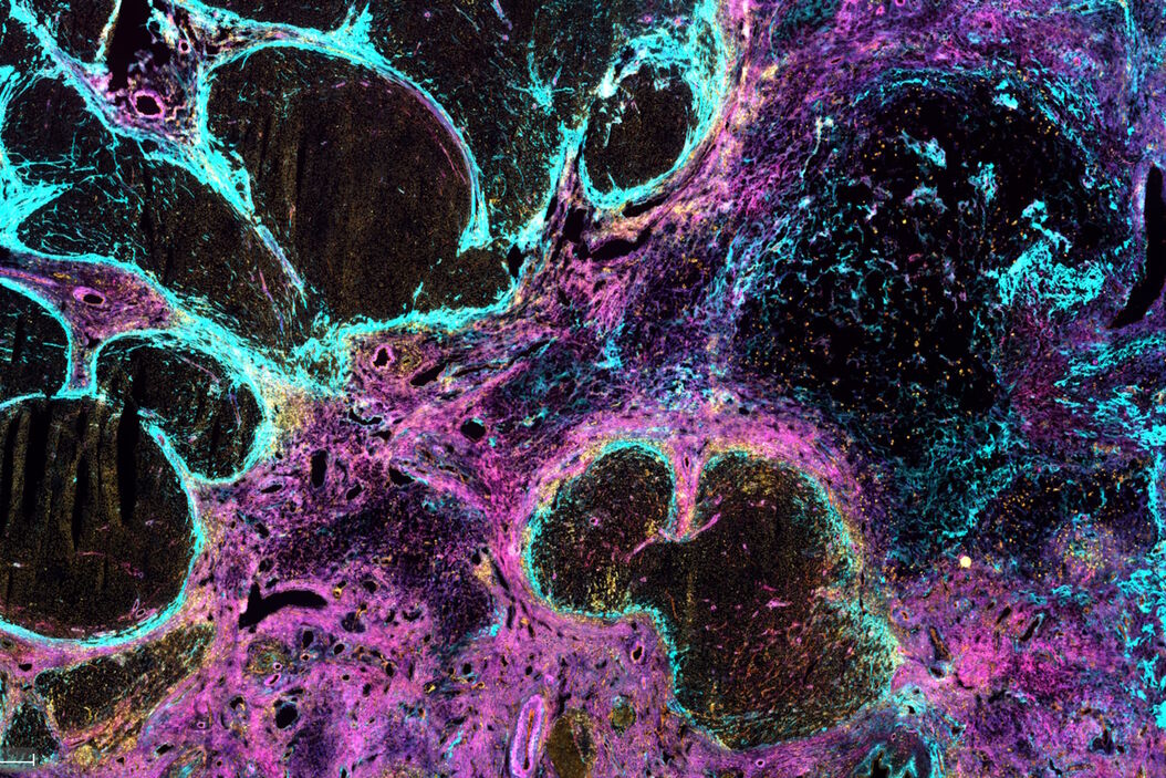 Gleichzeitiger Nachweis von 10 extrazellulären Matrixproteinen und 3 topografischen Gewebelandmarken durch Multiplex-Immunfärbung in einem einzelnen hochgradigen fibrösen Hotspot eines menschlichen hepatozellulären Karzinoms. Single_high-grade_fibrous_hotspot_from_a_human_hepatocellular_carcinoma.jpg