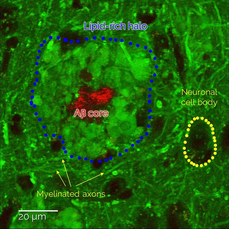 Amyloid-β-Plaques und damit verbundene pathologische Lipidablagerungen, visualisiert in nicht markiertem Hirngewebe. Die spektroskopische Analyse zeigt eine Anreicherung von Membranlipiden und einen Abbau von Cholesterin im Vergleich zu benachbarten gesunden Gehirnstrukturen und öffnet ein neues Fenster zur Untersuchung der Verbindungen zwischen dem Lipidstoffwechsel und der Alzheimer-Pathologie. Probe mit freundlicher Genehmigung von Dr. Martin Fuhrmann, Andrea Baral, Deutsches Zentrum für neurodegenerative Erkrankungen, Bonn.