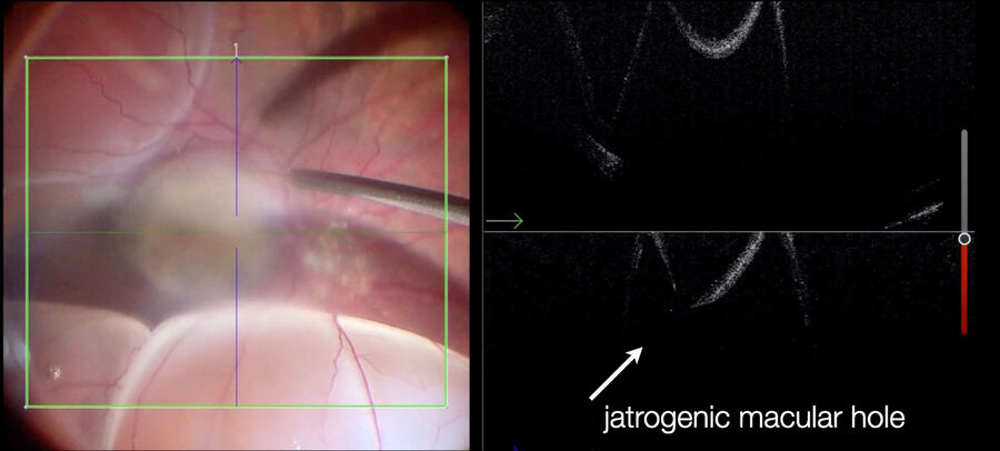 Intraoperative OCT shows an iatrogenically induced macular hole, while detaching the retina with subretinal injection of a balanced salt solution (BSS).