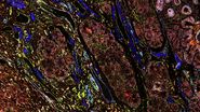 Pancreatic Ductal Adenocarcinoma with 11 Aerobic Glycolysis/Warburg Effect biomarkers shown – BCAT, Glut1, HK2, HTR2B, LDHA, NaKATPase, PCAD, PCK26, PKM2, SMA1, and Vimentin.