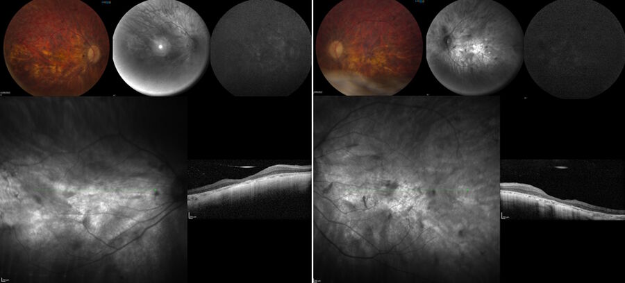 Figure 1: Pre-operative OCT and blue auto-fluorescence fundus images of the right eye (left) and of the left eye (right).