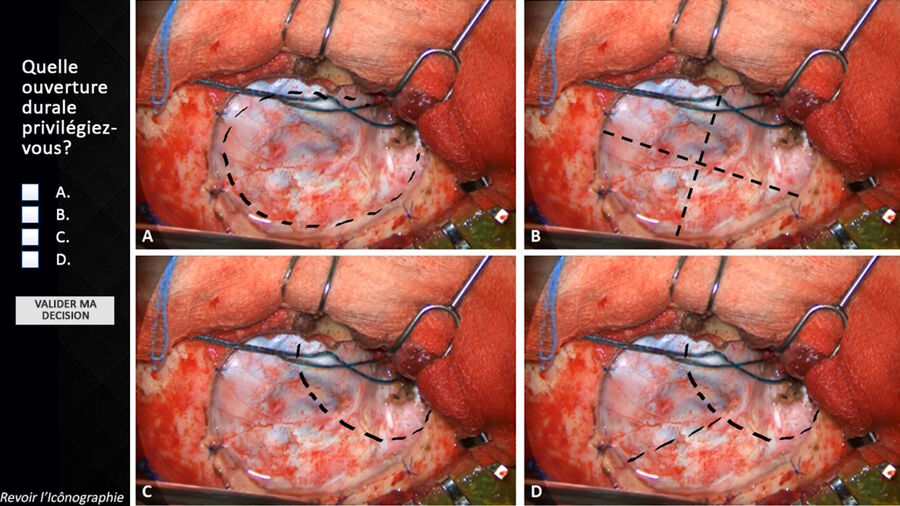 Example of SGION question and answers: which dural opening do you choose? Image courtesy of Dr. Lucas Troude.