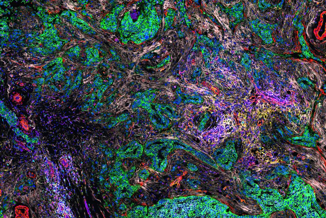 Cell DIVE multiplexed image of FFPE tissue section from human invasive ductal carcinoma (IDC) FFPE_tissue_section_from_human_invasive_ductal_carcinoma_.jpg