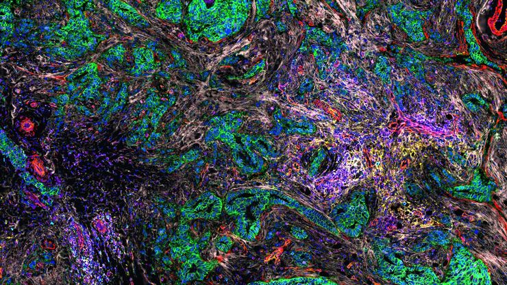 Cell DIVE multiplexed image of FFPE tissue section from human invasive ductal carcinoma (IDC)