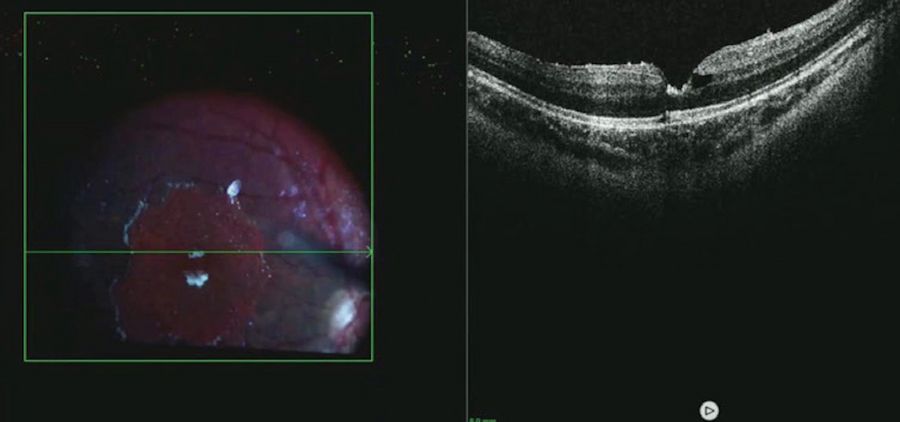 Intraoperative OCT provided valuable real-time insights on the configuration of the membrane, which can change after the hyaloid is lifted. mage courtesy of Robert A. Sisk, MD, FACS, Cincinnati Eye Institute.