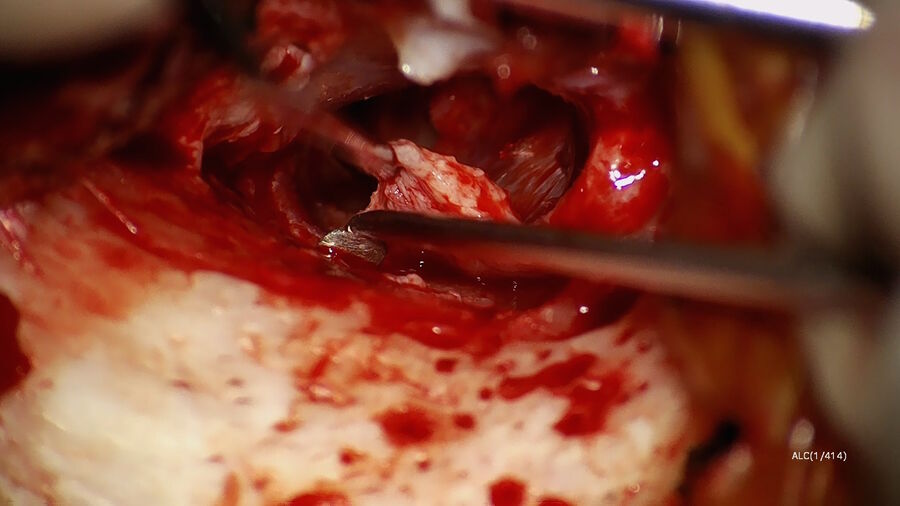 Figure 1: Elevation of the tympanomeatal flap. Image courtesy of Dr. Sean Flanagan
