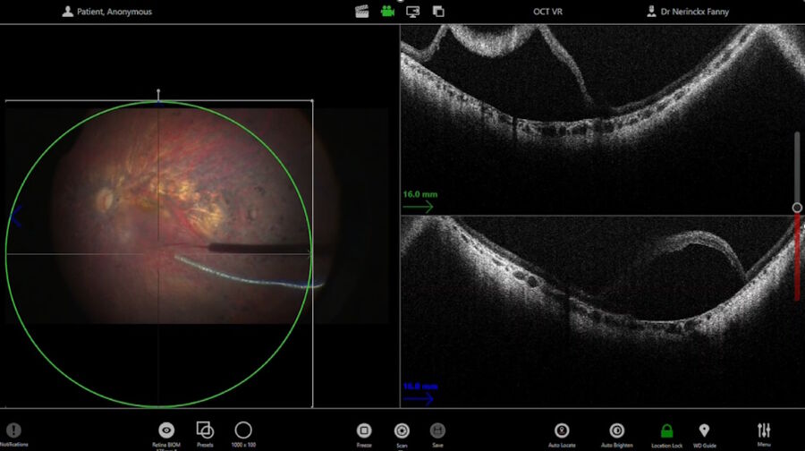 Figure 5: The use of intraoperative OCT supports control of bleb placement. 