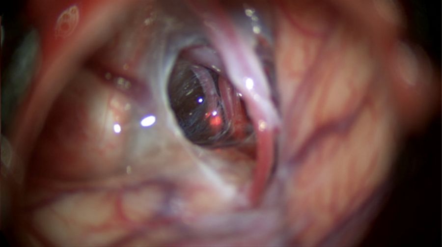 Removal of the membrane from the carotid oculomotor and exposing of the posterior communicating artery.