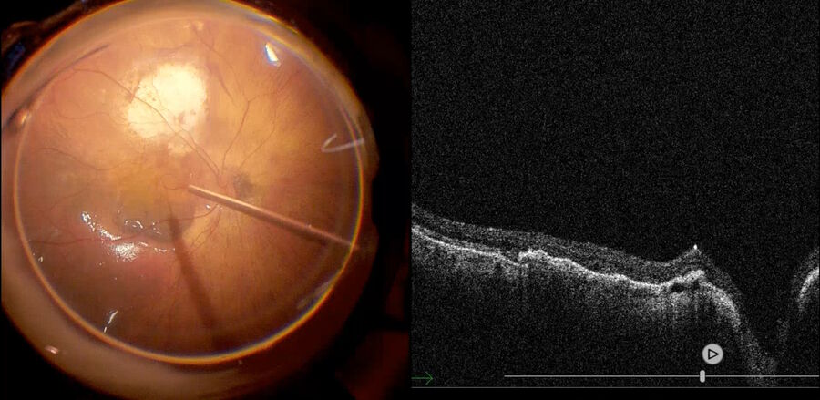 Fig. 13: Perfluorocarbon liquid (PFCL) was used for creating subretinal space and an RPE patch was excised and moved toward the macular region. The figure shows the RPE patch being placed in the macular region. EnFocus intraoperative OCT was used to scan the posterior pole to obtain the position of the transplant.