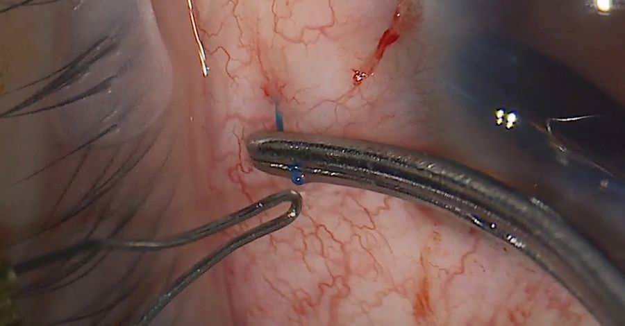 Low temperature cautery used to bulb the end of the haptic. Image courtesy of Arsham Sheybani, MD, Washington University School of Medicine.