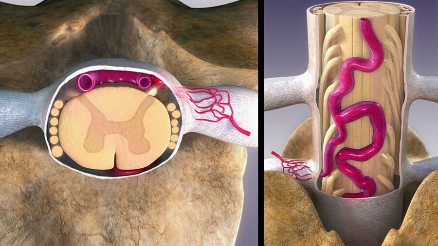 Dorsal intradural arterio-venous fistulas. SpetzlerR, KalaniMY, NakajiP; NeurovascularSurgery; 2nd Edition; Thieme