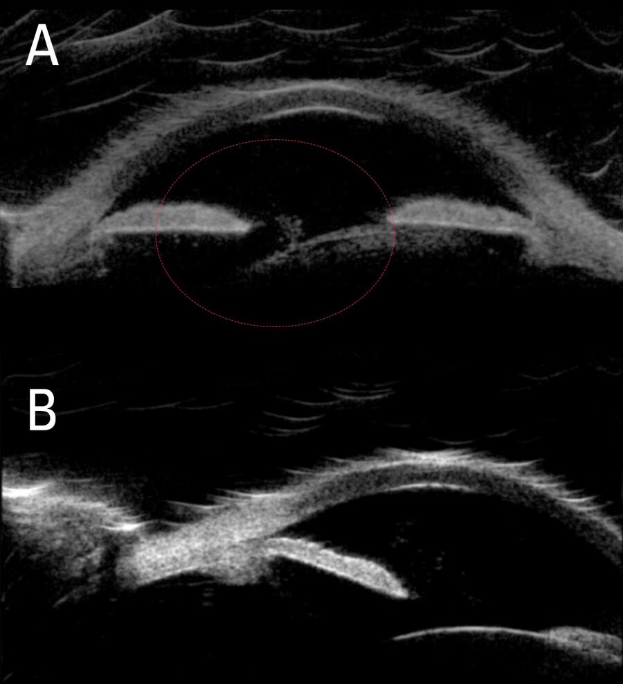 Pre-operative intraoperative OCT scans revealed a tuft of vitreous in the anterior chamber (A) and a severely tilted lens (B). Images courtesy of Arsham Sheybani, MD, Washington University School of Medicine.