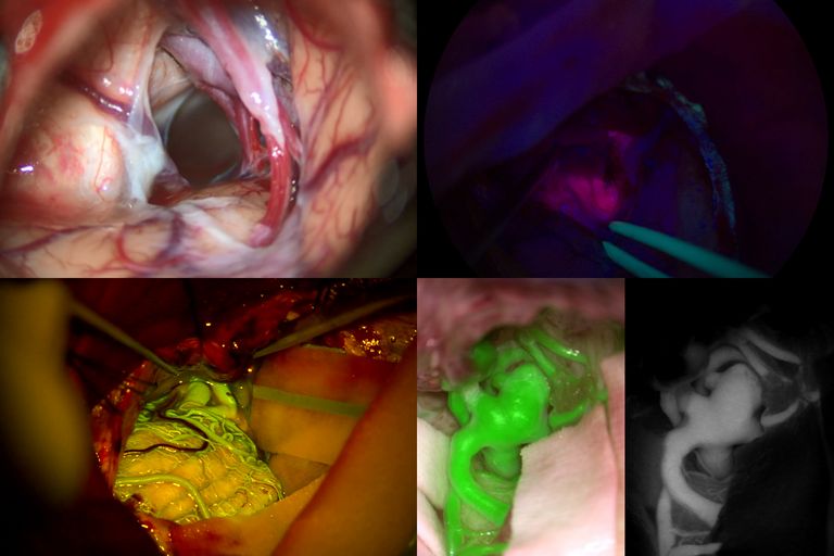 Augment your intra operative visualization with your choice of fluorescence imaging.