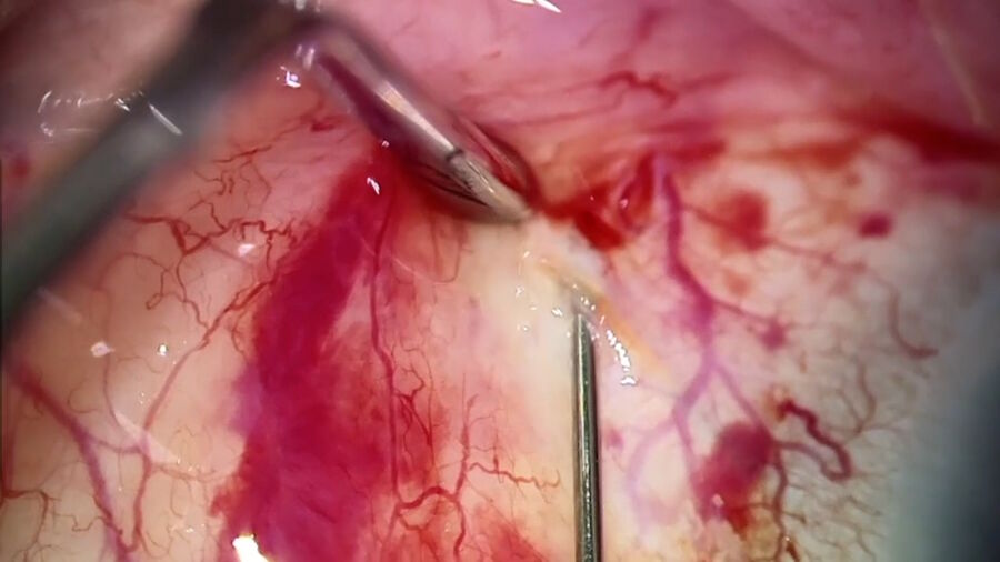 Examination of old subconjunctival stent after peritomy revealed surrounding Tenon's tissue. Image courtesy of Arsham Sheybani, MD, Washington University School of Medicine.