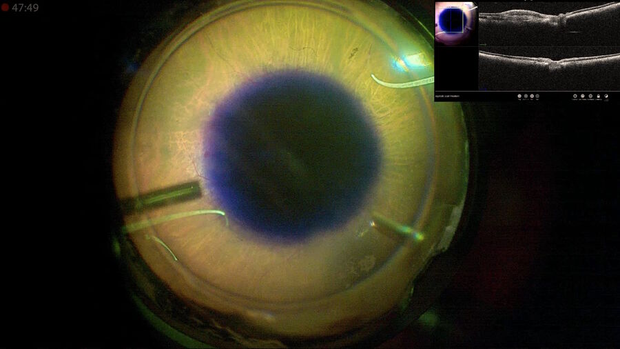 Fig. 16: Brilliant blue dye is used worldwide for staining internal limiting membranes. The EnFocus intraoperative OCT image is depicted in the picture-in-picture. The OCT light beam can pass through the dye with no interference.