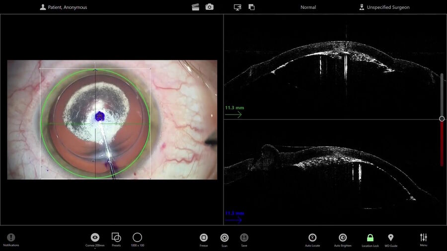 Figure 2: Resolution plays an important role for intraoperative OCT in lamellar corneal transplantation. Image courtesy of Prof. Fontana.