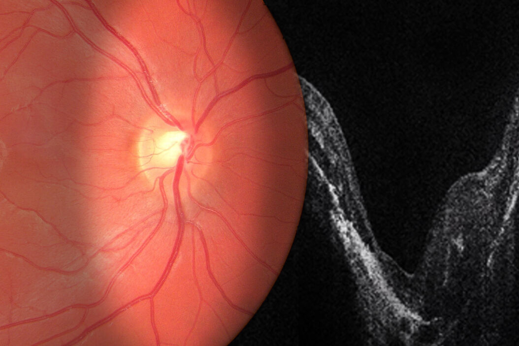OCT-Guided Retina Surgery OCT-Guided Retina Surgery OCT-Guided_Retina_Surgery_Clinical_Symposium_Prof_Gavin_Tan_teaser.jpg