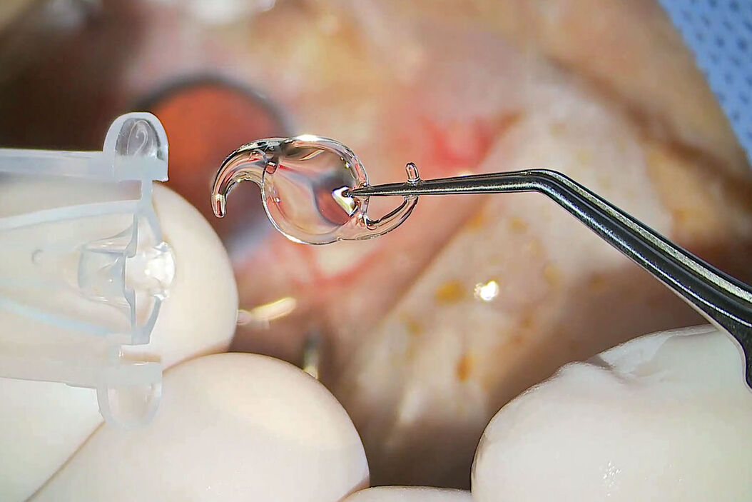  proveo-abstract-cataract.jpg
